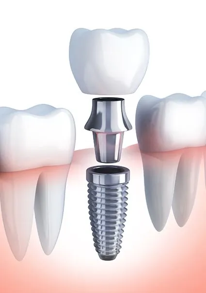 Illustration of a dental implant with a crown between two natural teeth