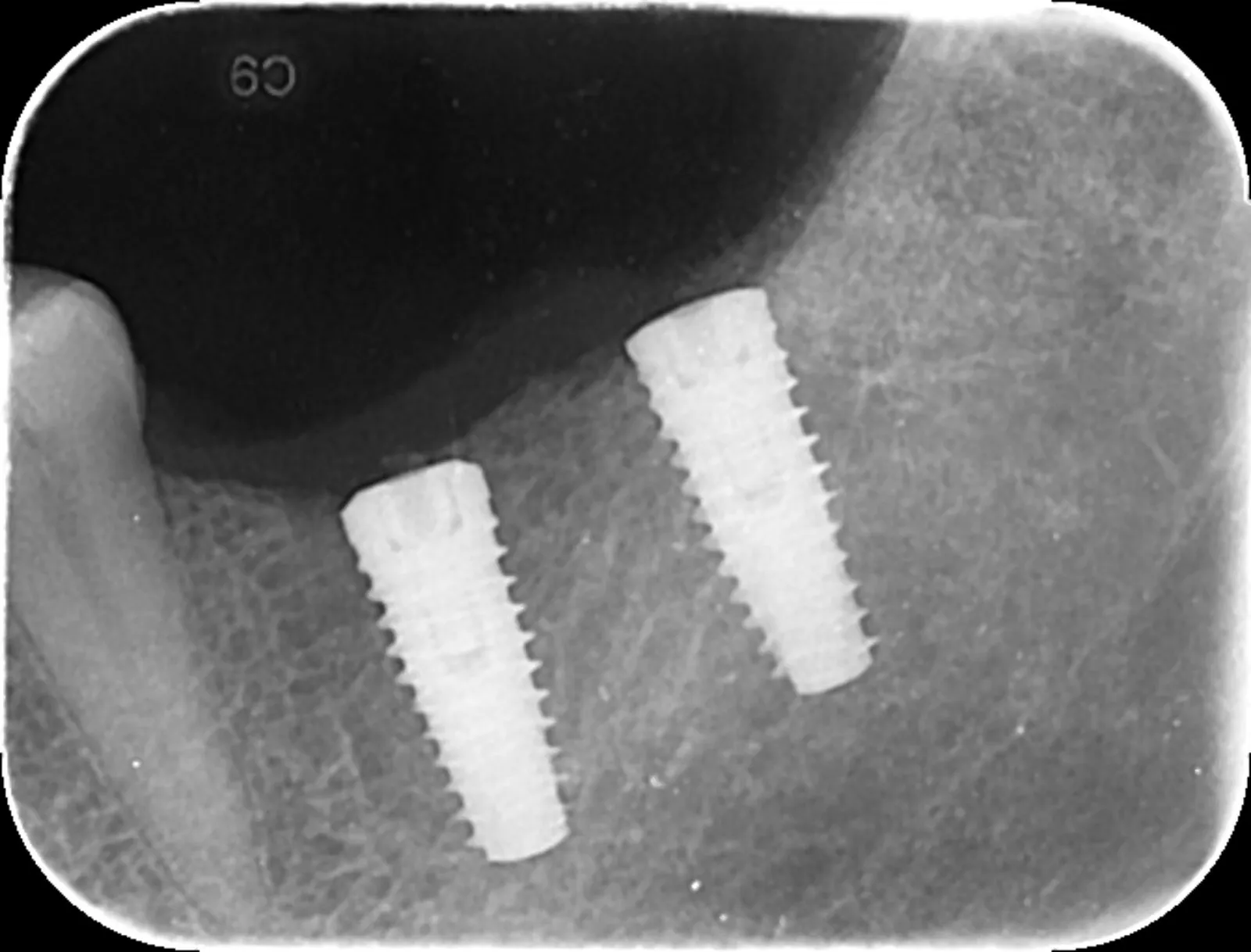 X-ray showing two dental implants placed in the jaw